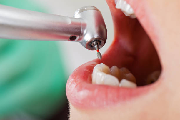 Best Emergency Treatment for Dental Infections or Abscesses in USA